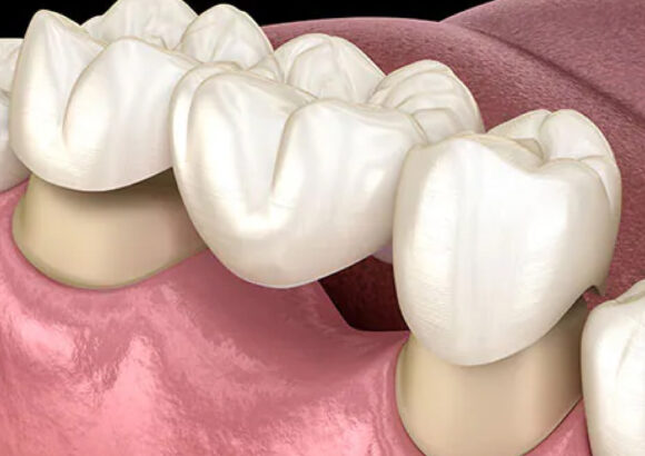 Dental Crowns and Bridges