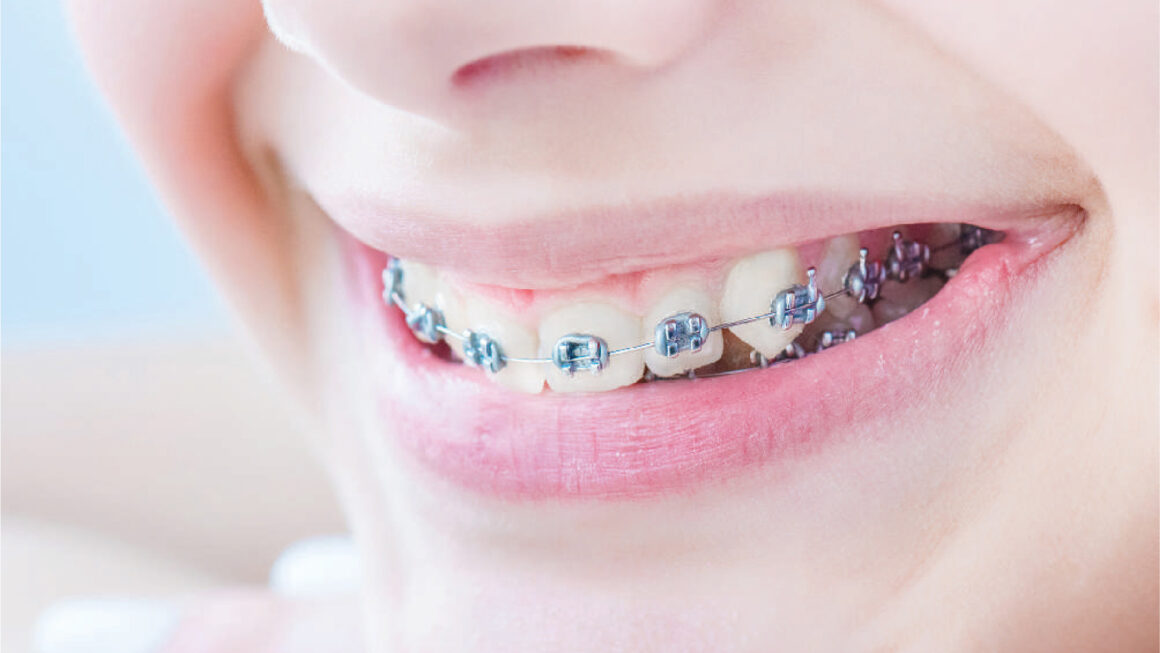 Braces: Benefits and Indications