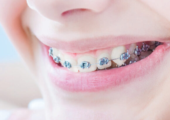 Braces: Benefits and Indications