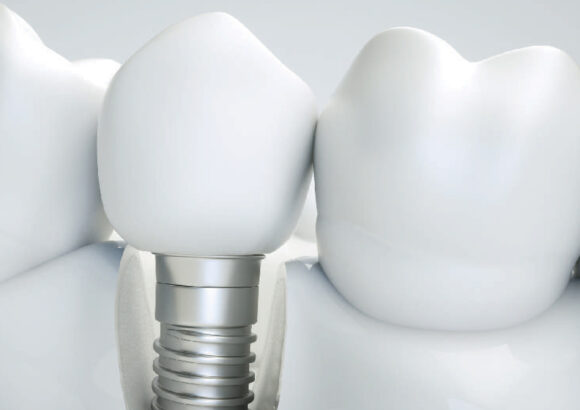 Dental Implants