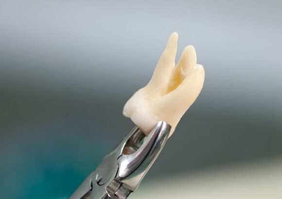 Tooth Extraction